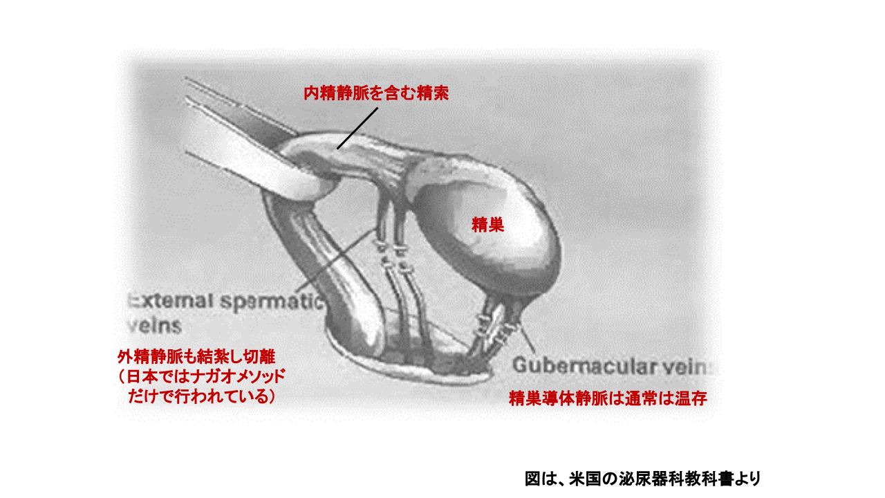 顕微鏡下精索静脈瘤低位（鼠径下）結紮手術　2019.4シュレーゲル教授招請講演のスライド