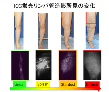 ICG蛍光リChanges in ICG fluorescent lymphangiography findings
