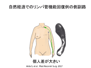 Collateral pathways in cases of spontaneous recovery of lymphatic function (figure below)
