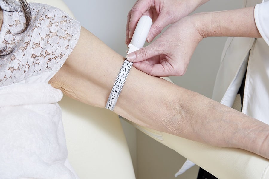 Measurement before lymphedema surgery  Upper limb