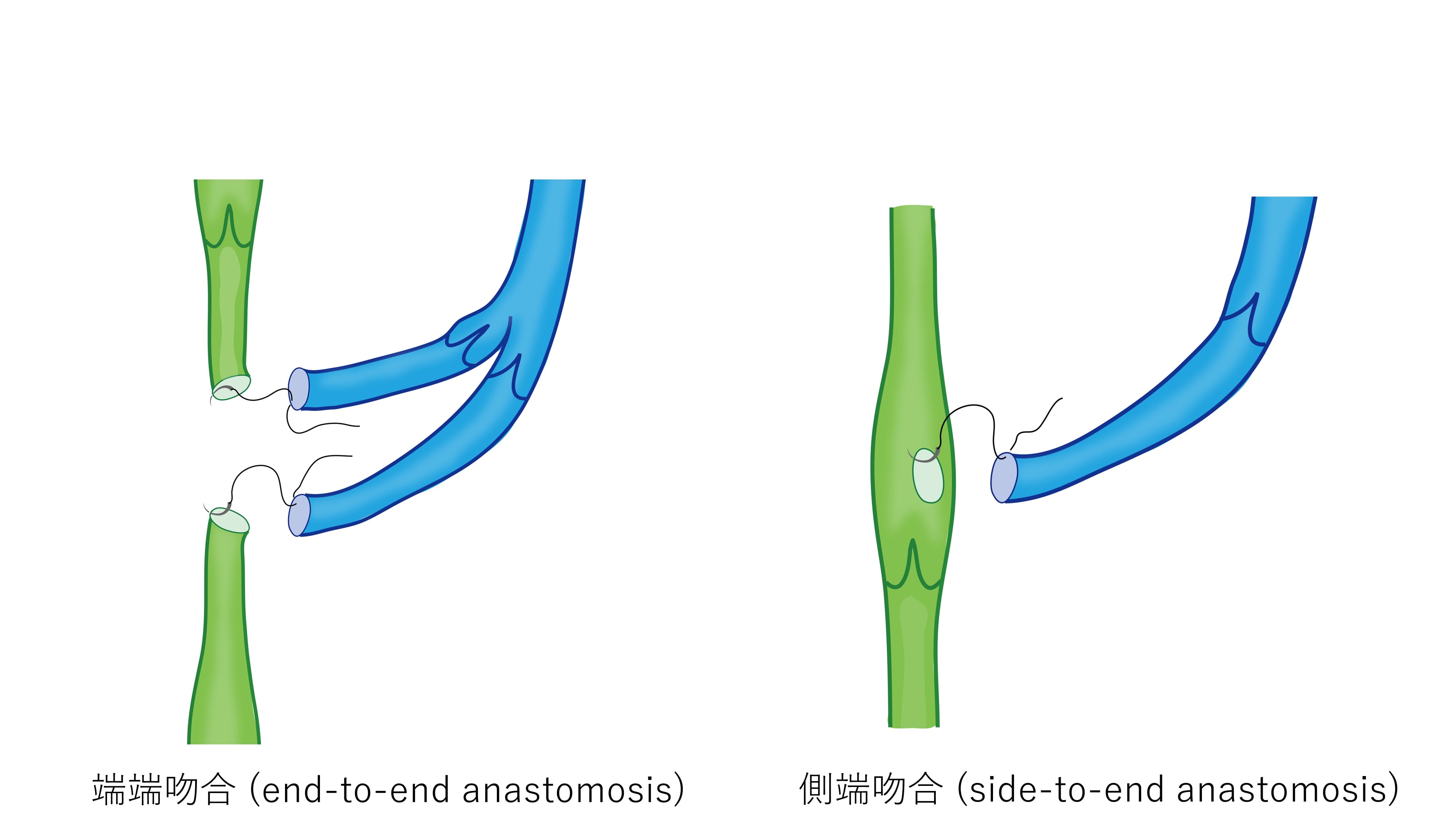 リンパ管と静脈を吻合する