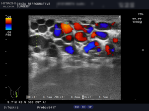 精索静脈瘤エコー検査_左側1枚目