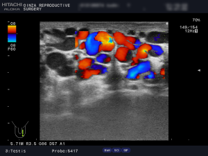 精索静脈瘤エコー検査_左側2枚目