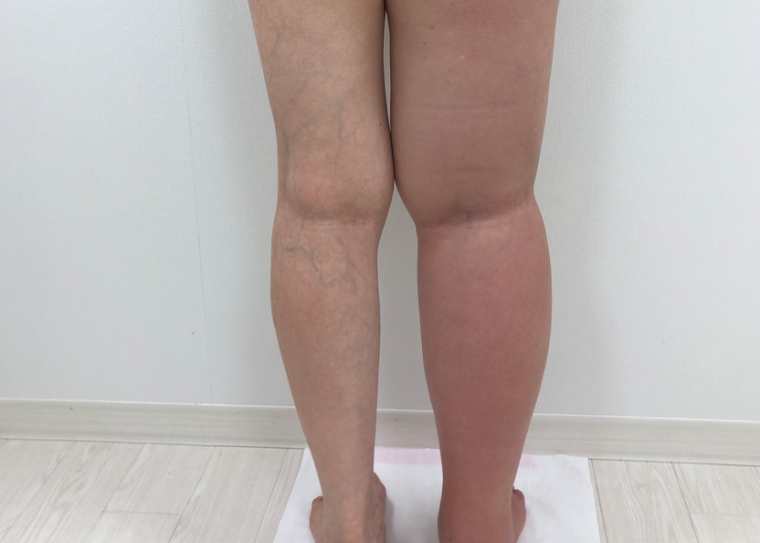 術前の患者様の正面お写真