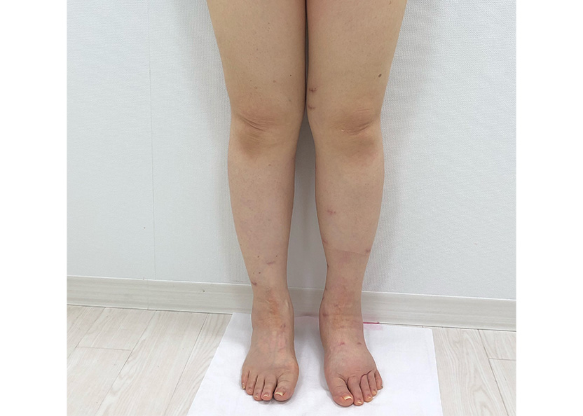 術後前方からのお写真