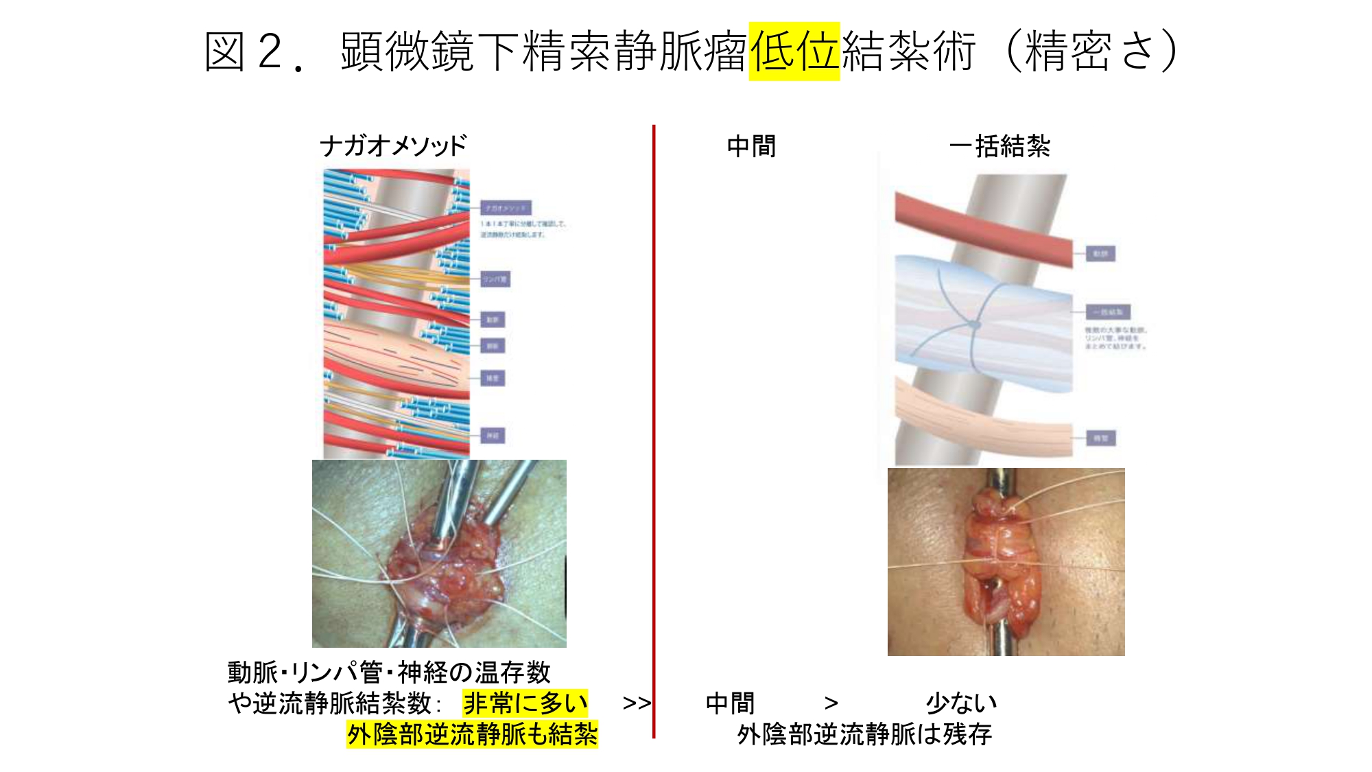 図2. 顕微鏡下精索静脈瘤低位結紮術（精密さ）