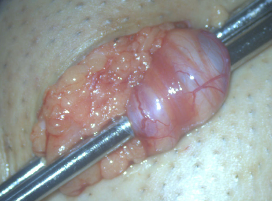 精索静脈瘤手術手順