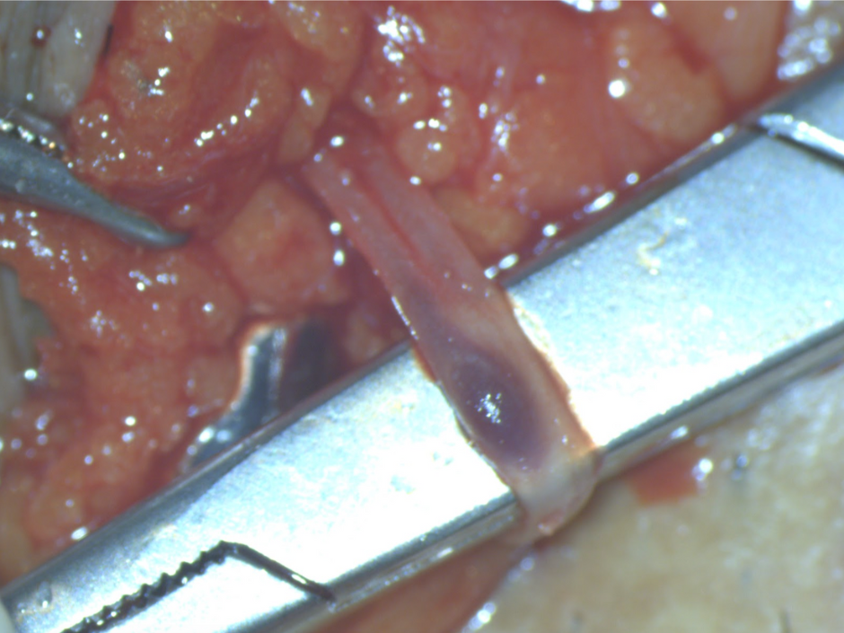 精索静脈瘤手術手順