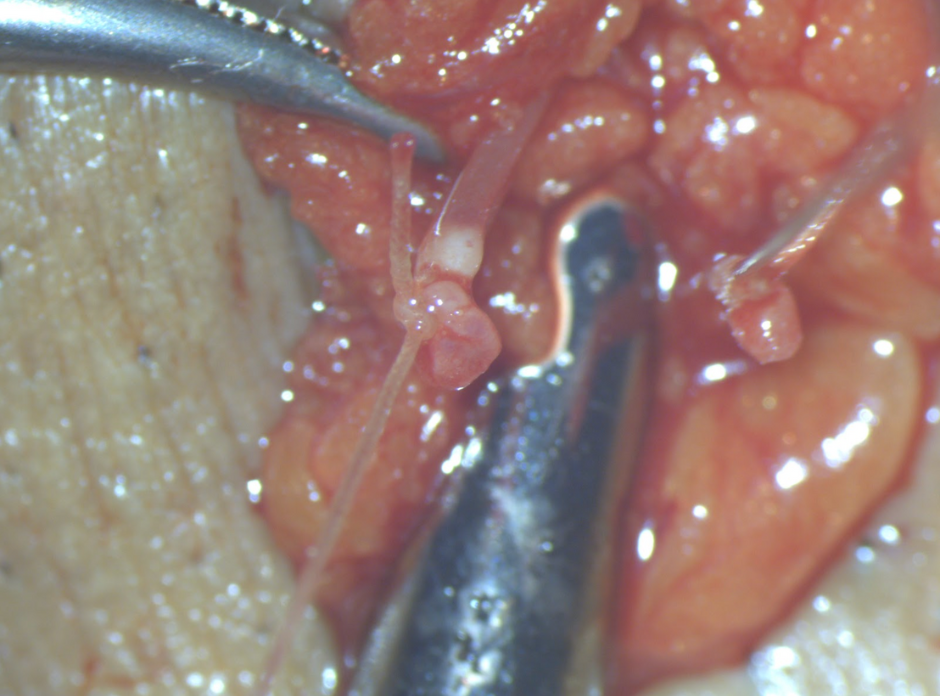 精索静脈瘤手術手順