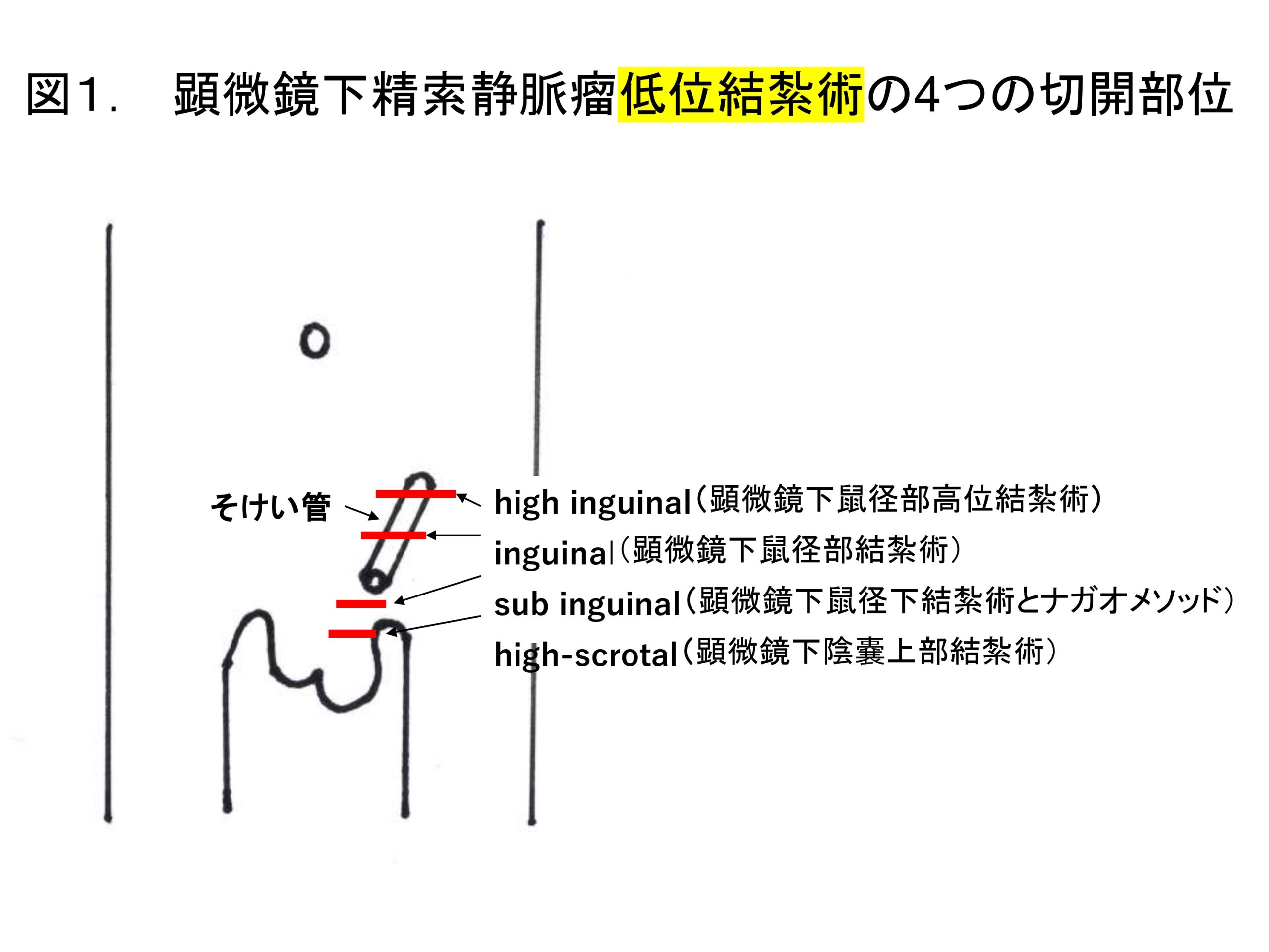 図1. 顕微鏡下精索静脈瘤低位結紮術の4つの切開部位
