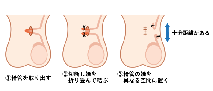 パイプカット手術